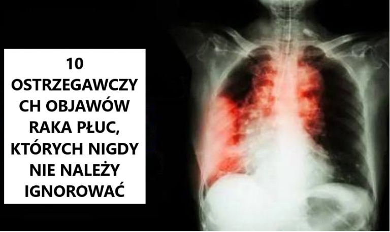 10 ostrzegawczych objawów raka płuc, które każdy powinien znać