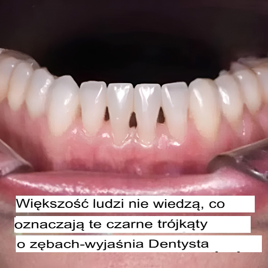 Co oznaczają czarne trójkąty między zębami? Dentysta wyjaśnia!