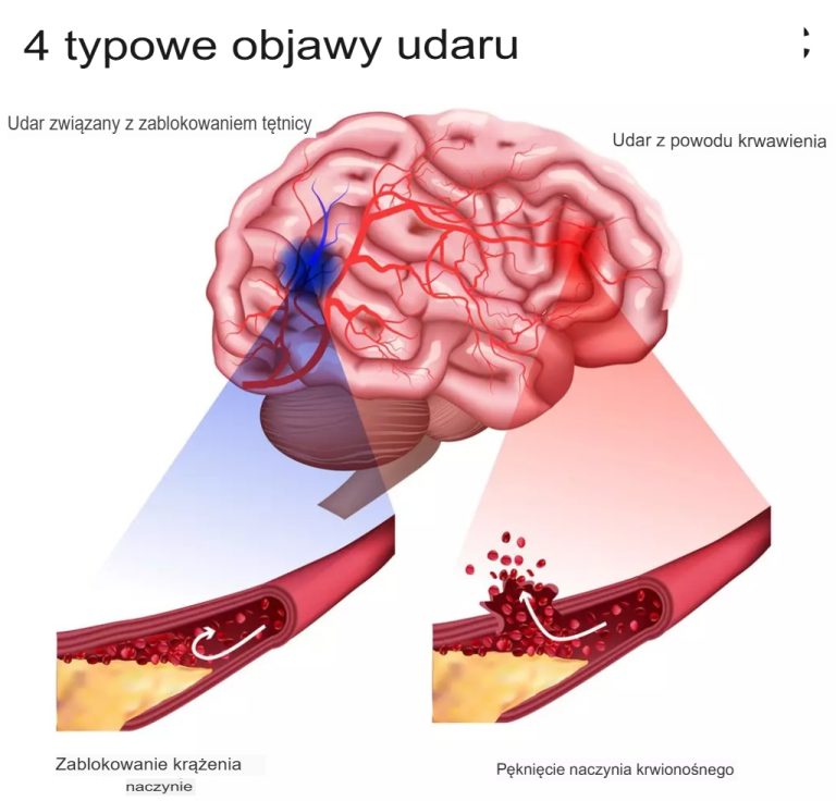 4 typowe objawy udaru mózgu