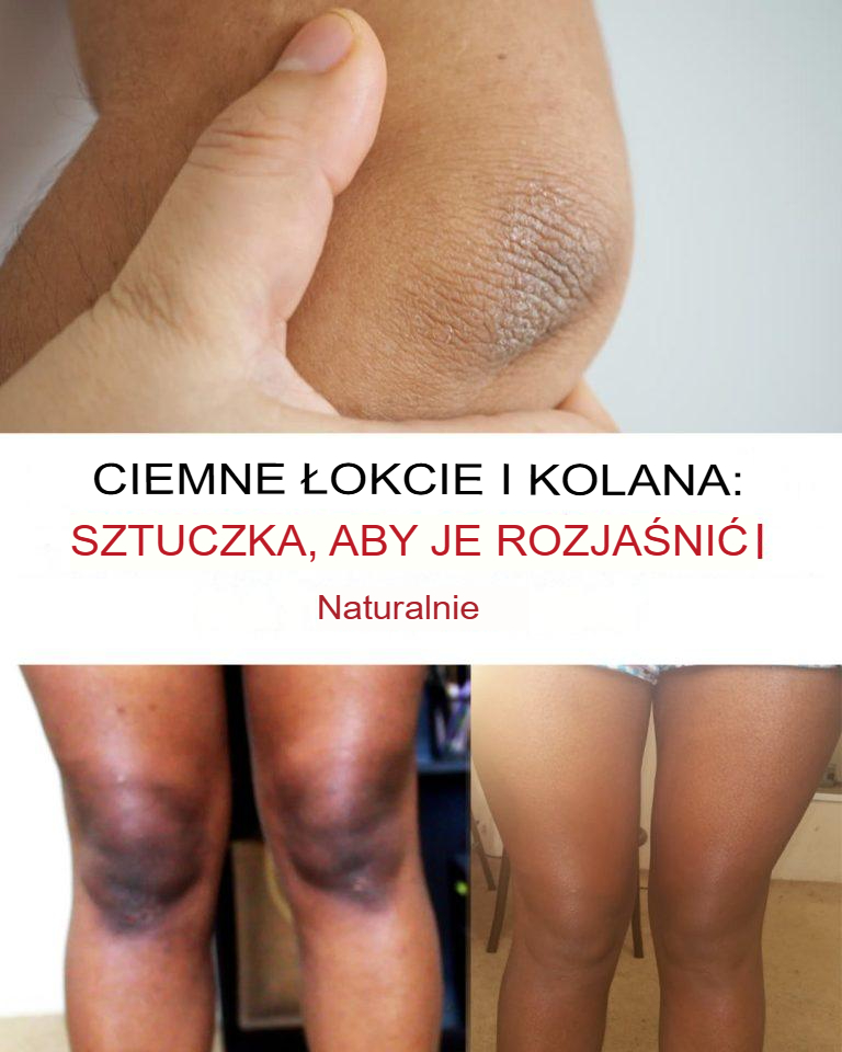 Naturalne Sposoby na Rozjaśnienie Łokci i Kolan!