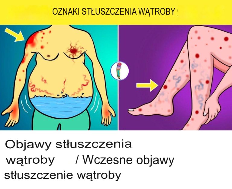 Objawy Stłuszczenia Wątroby – Wczesne Oznaki, Których Nie Można Ignorować