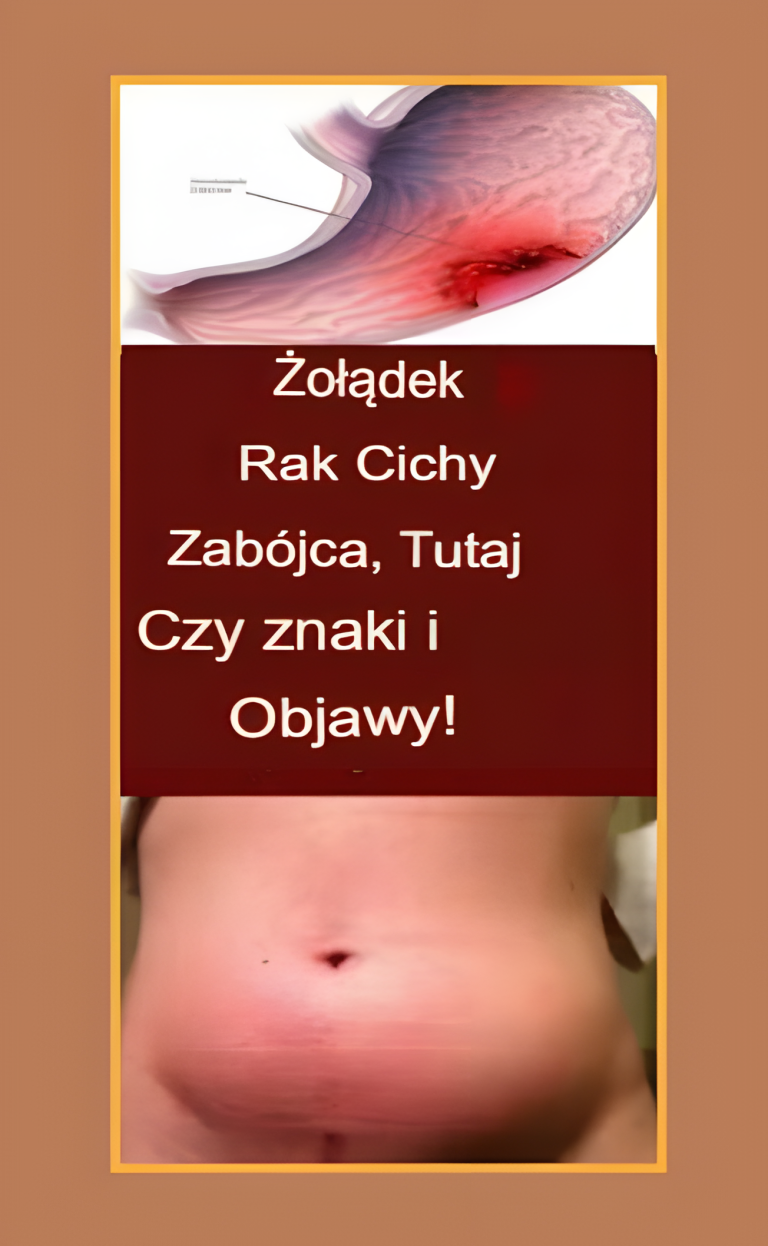 10 objawy Rak żołądka – cichy zabójca, którego nie wolno lekceważyć
