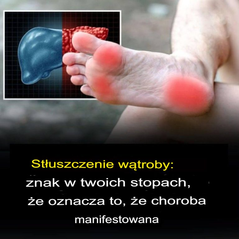 Stłuszczenie wątroby: objawy na stopach wskazujące na postęp choroby