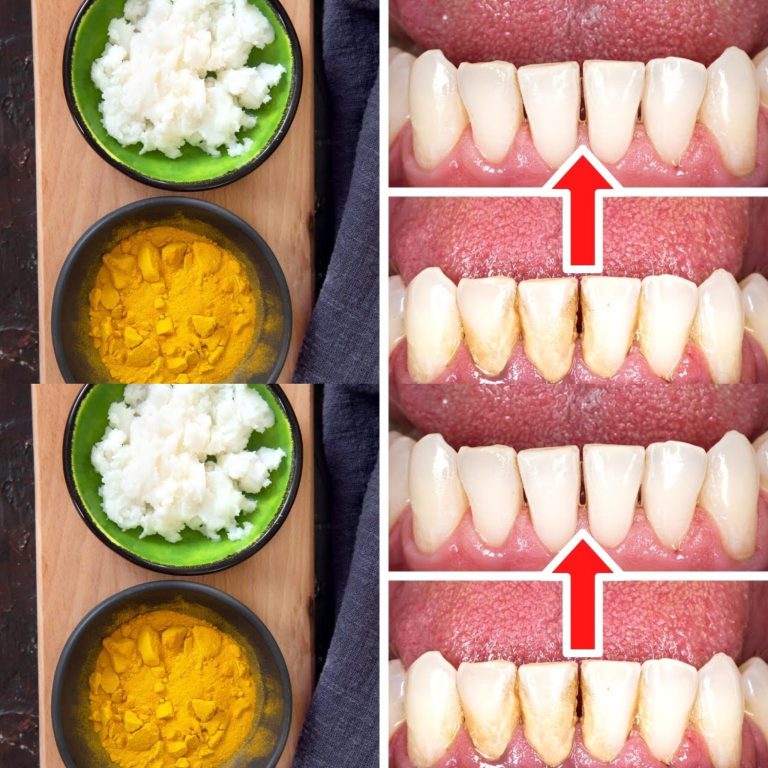 Jak usunąć kamień i osad nazębny bez dentysty: kurkuma i sól