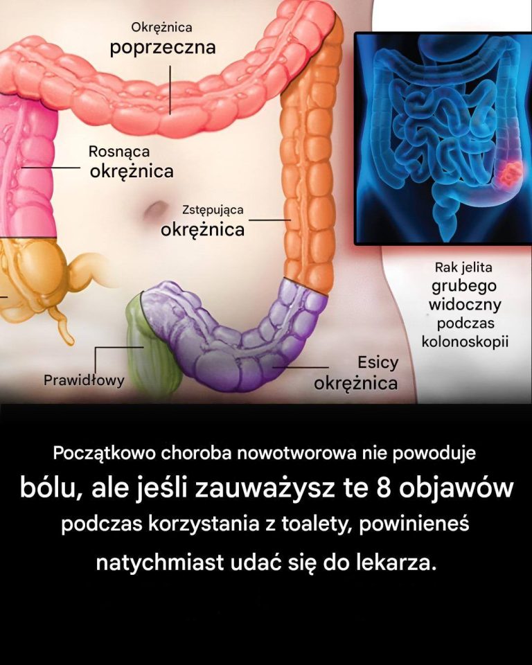 Rak jelita grubego zazwyczaj we wczesnym stadium nie daje żadnych objawów. Istnieje 7 objawów, które możesz zlekceważyć, a które pojawiają się na początku choroby.