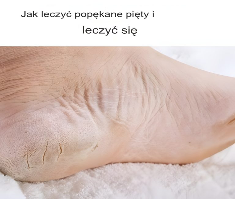 Jak leczyć i leczyć popękane pięty