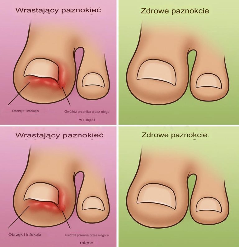 Wrastające paznokcie u stóp: Jak szybko i naturalnie sobie z nimi poradzić w domu