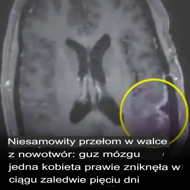 Przełom w leczeniu raka: Guz mózgu kobiety prawie zniknął w ciągu zaledwie pięciu dni