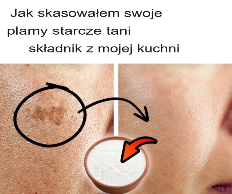 Jak pozbyłam się plam starczych za pomocą taniego składnika z mojej kuchni