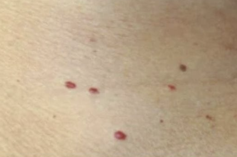 Jeśli zauważysz te czerwone kropki na skórze, oto co one oznaczają