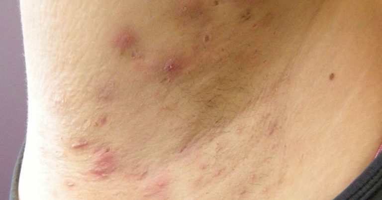 Nazwane na cześć lekarza, który je opisał, ropne zapalenie gruczołów potowych (hidradenitis suppurativa) to schorzenie dermatologiczne, znane również jako zapalenie gruczołów potowych. Poznaj jego przyczyny, objawy i naturalne metody leczenia, aby złagodzić tę bolesną dolegliwość, która może dotyczyć wielu części ciała.