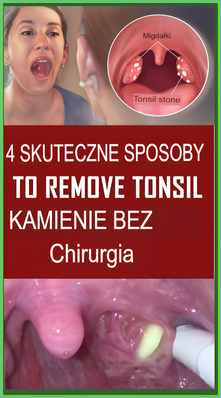 4 skuteczne sposoby na usunięcie kamieni migdałkowych bez operacji