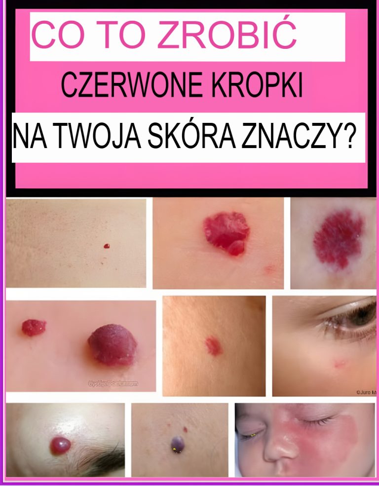 Co oznaczają czerwone znamiona na ciele?