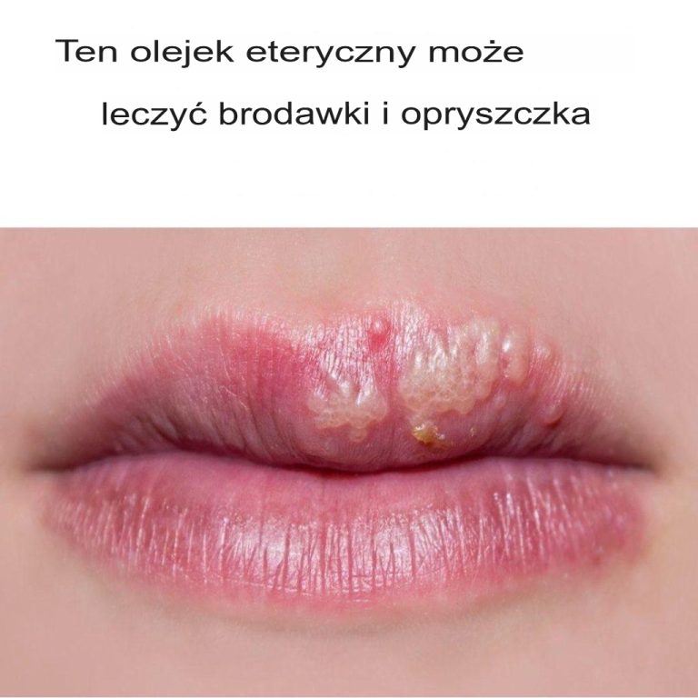 Olejek z drzewa herbacianego na brodawki i opryszczkę