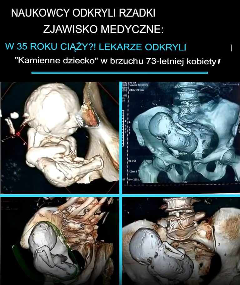 🪨 35 lat w ciąży?! Lekarze odkryli „ceglane dziecko” w brzuchu 73-letniej kobiety