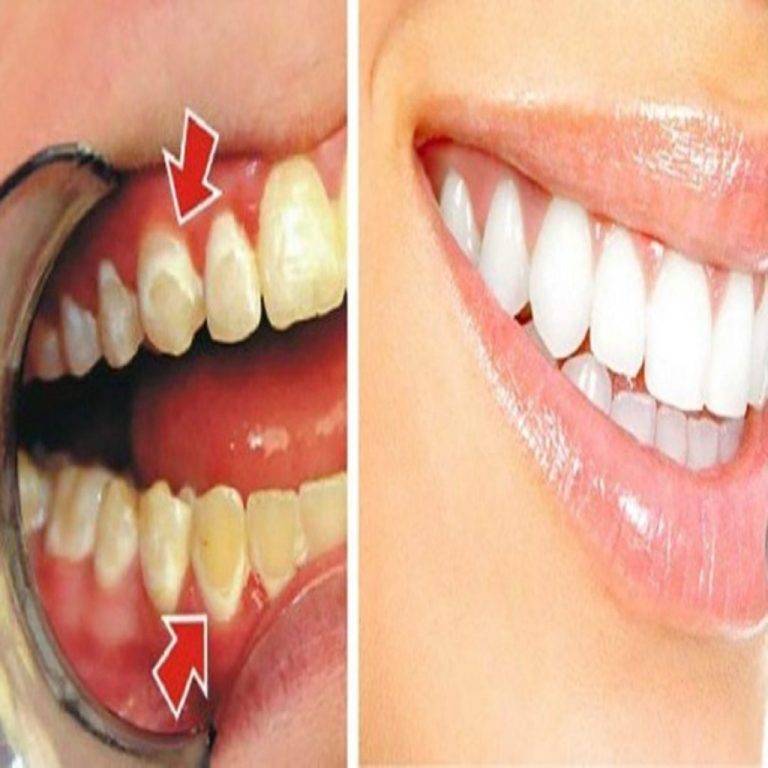 Zostań swoim własnym dentystą! Oto jak usunąć płytkę nazębną z zębów w zaledwie 5 minut!