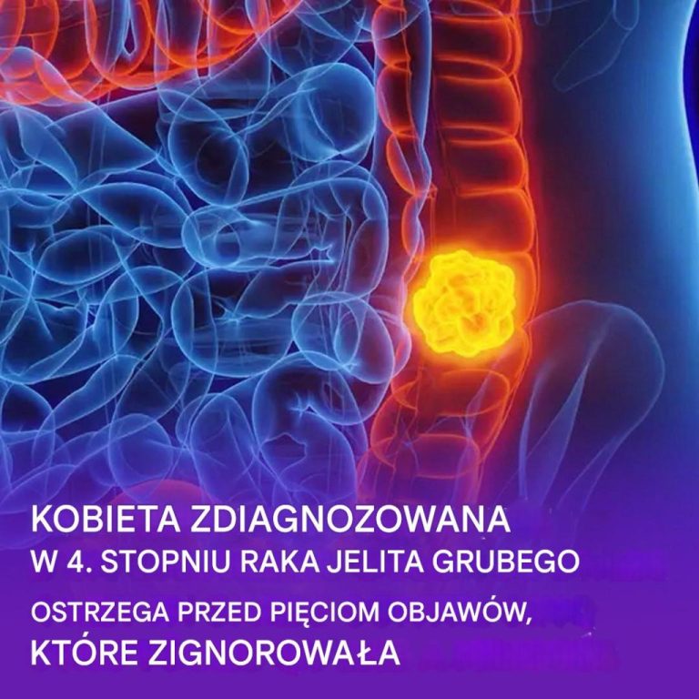 Kobieta ujawnia pięć objawów raka jelita grubego, których nie należy ignorować