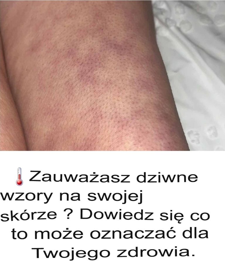 Zauważasz dziwne wzory na skórze? Dowiedz się, co mogą oznaczać dla Twojego zdrowia.