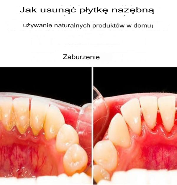 Jak usunąć płytkę nazębną naturalnie w domu i w naturalnych warunkach