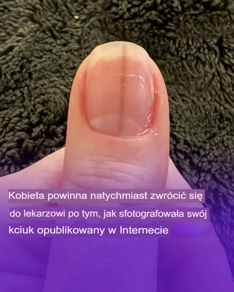 Kobiecie nakazano natychmiastową wizytę u lekarza po udostępnieniu w internecie zdjęcia swojego kciuka