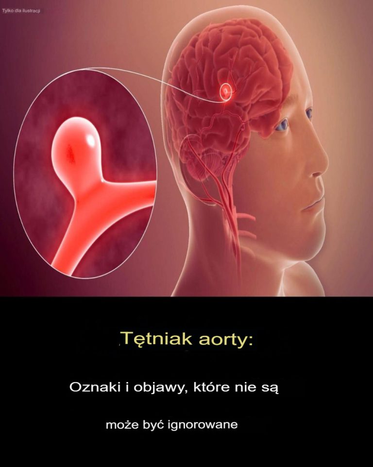 12 ostrzegawczych objawów tętniaka, których nie należy ignorować