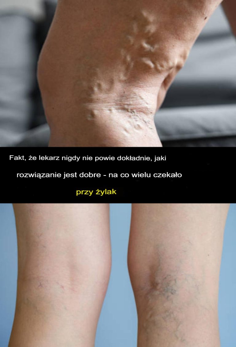 To, czego Twój lekarz nigdy Ci nie powie, okazuje się rozwiązaniem, na które czekało wiele osób w walce z żylakami