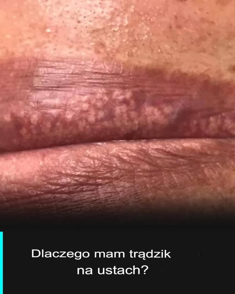 Miejsca Fordyce: wszystko, co musisz wiedzieć