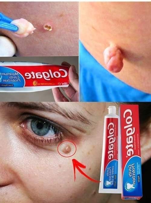 Usuń ciemne plamy, ciemne smugi i naturalne przebarwienia