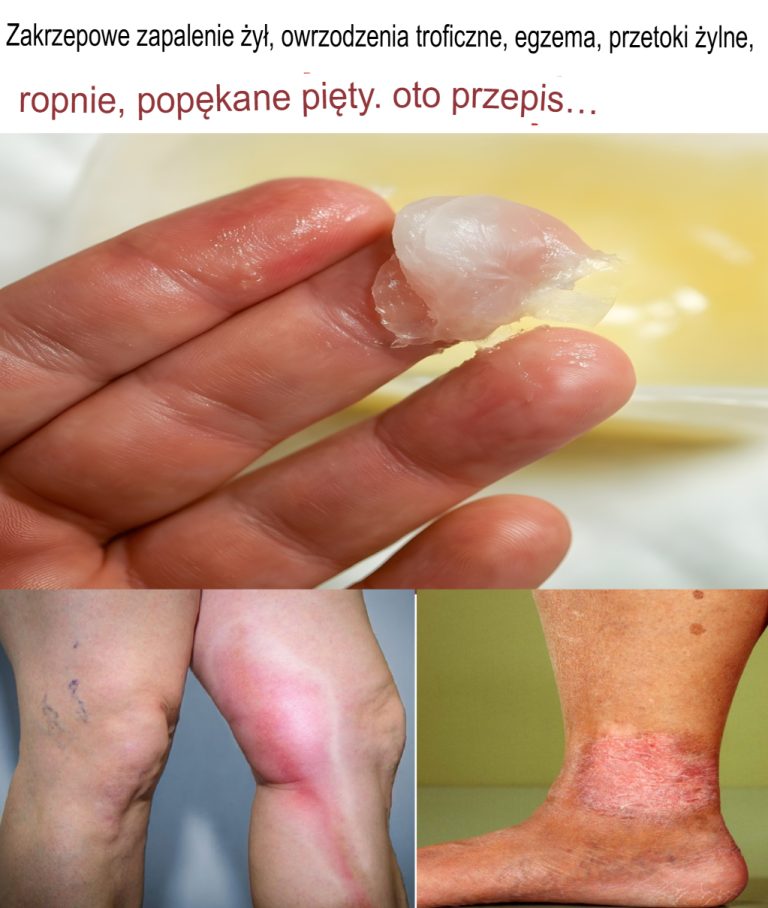 Zakrzepowe zapalenie żył, owrzodzenia troficzne, egzema, przetoki żylne, ropnie, popękane pięty. Oto przepis.