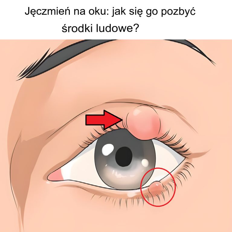 Jęczmień w oku: jak się go pozbyć domowymi sposobami?