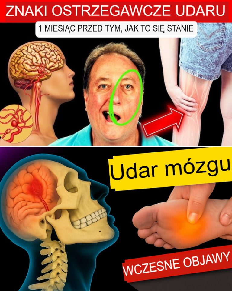 8 ostrzegawczych objawów udaru i 9 wskazówek, jak mu zapobiegać