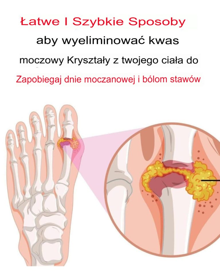 Jak naturalnie odwrócić dnę moczanową i złagodzić ból stawów