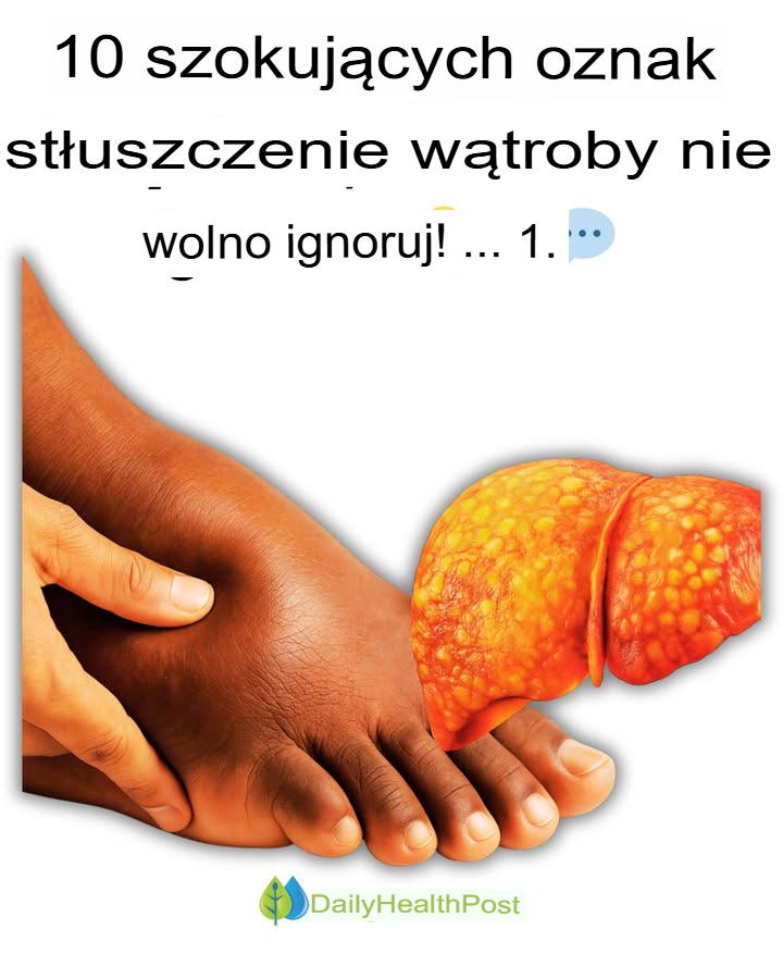 10 szokujących objawów stłuszczenia wątroby, których nie wolno ignorować!