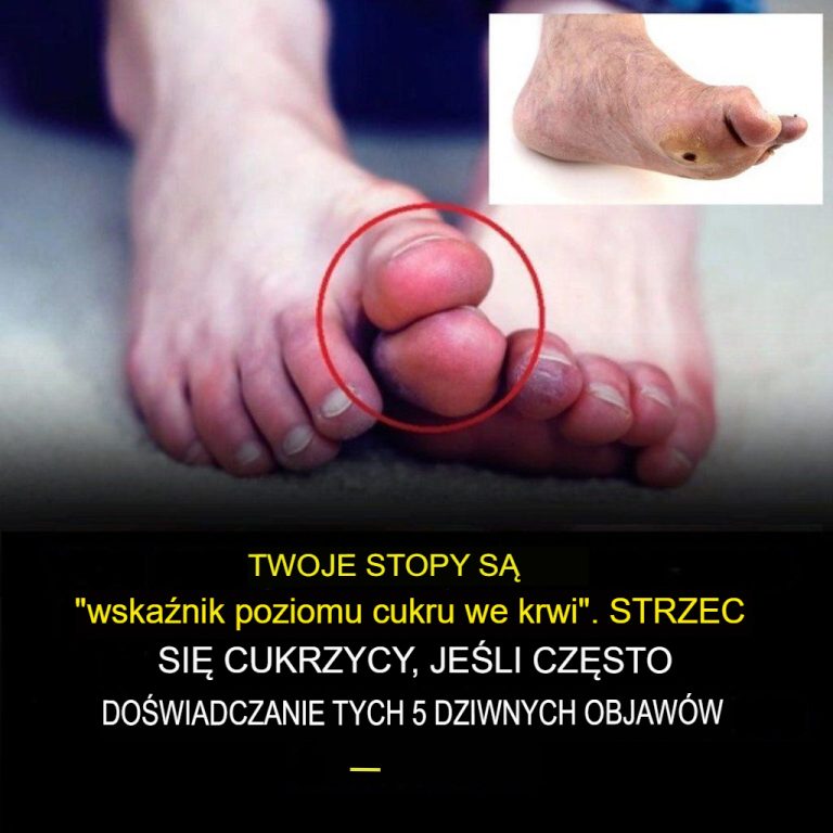 Oto pięć nietypowych objawów wysokiego poziomu cukru we krwi, na które należy zwrócić uwagę w przypadku stóp.
