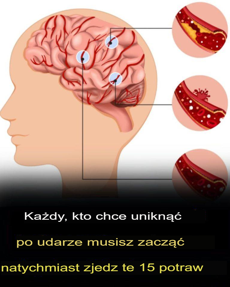 Każdy, kto chce uniknąć udaru, powinien natychmiast zacząć jeść te 15 produktów