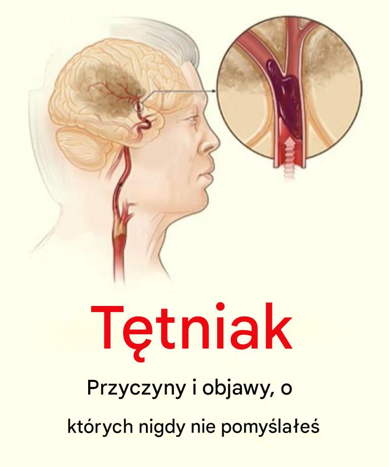 7 nawyków, które pomagają zmniejszyć ryzyko wystąpienia tętniaka