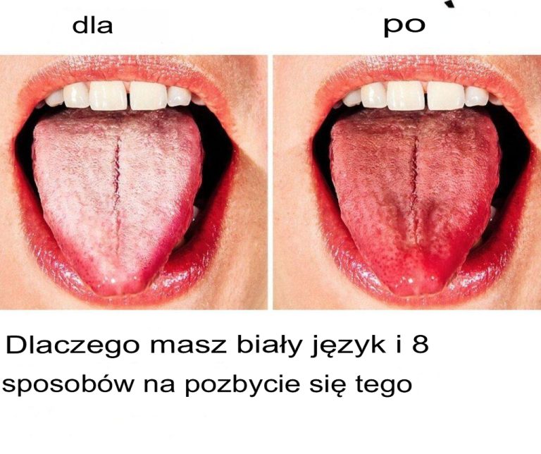 Dlaczego język robi się biały i 8 sposobów, jak się go pozbyć