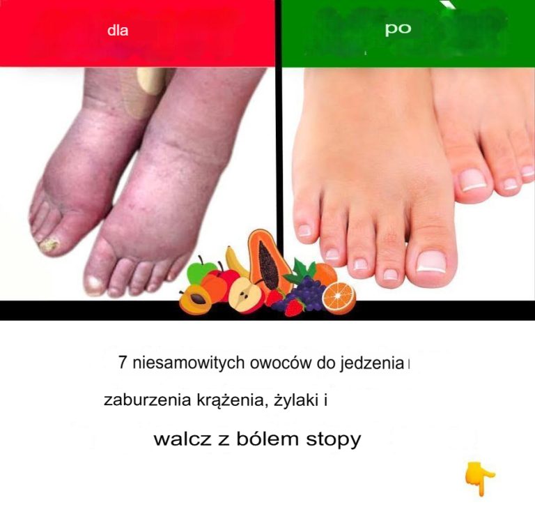7 wspaniałych owoców na zaburzenia krążenia, żylaki i ból nóg