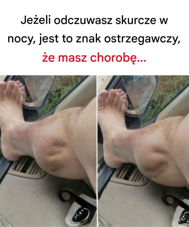 Co skurcze nóg mówią o zdrowiu nerek?