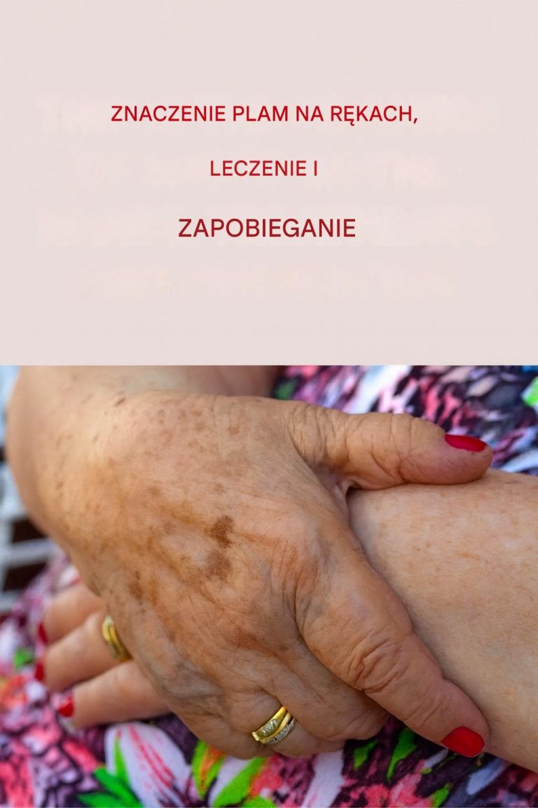 Znaczenie plam na dłoniach – oraz proste sposoby na ich naturalne leczenie i zapobieganie