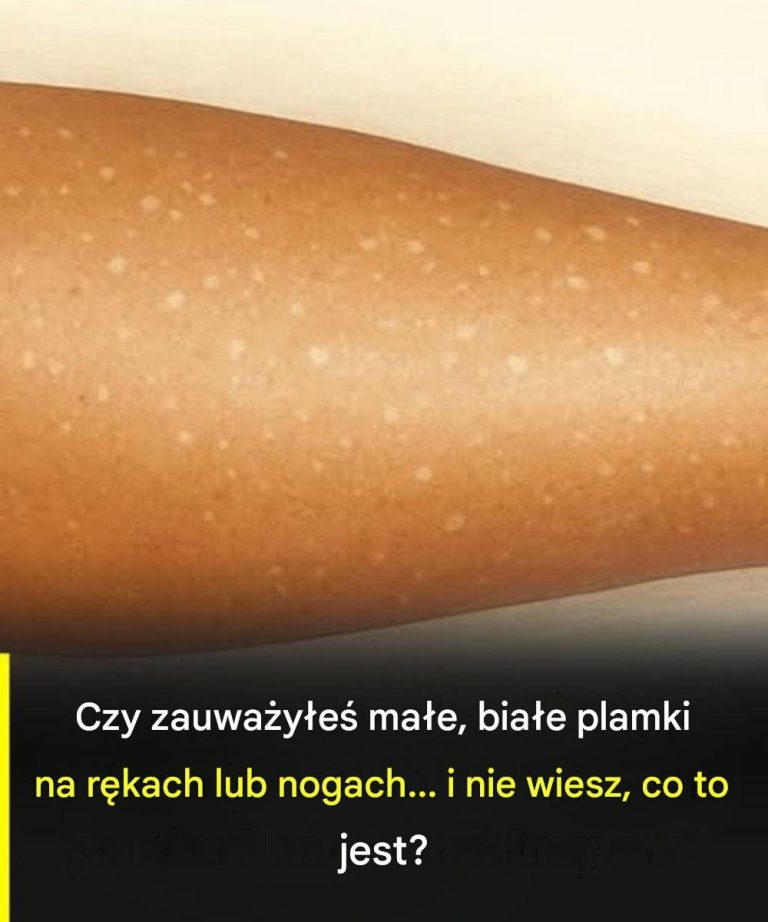 Białe plamy na skórze: niedobory jakich witamin mogą być przyczyną?